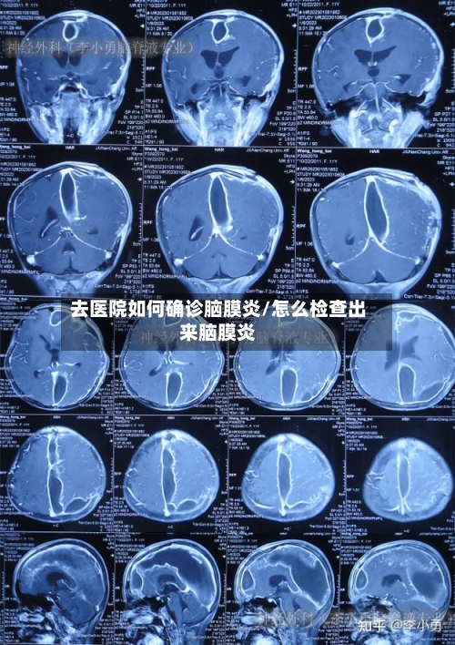 去医院如何确诊脑膜炎/怎么检查出来脑膜炎