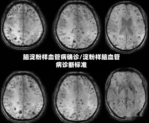 脑淀粉样血管病确诊/淀粉样脑血管病诊断标准