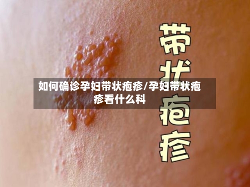 如何确诊孕妇带状疱疹/孕妇带状疱疹看什么科-第2张图片