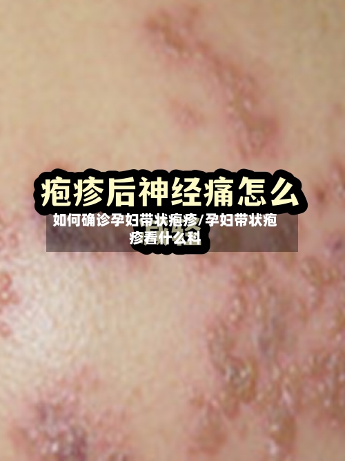 如何确诊孕妇带状疱疹/孕妇带状疱疹看什么科