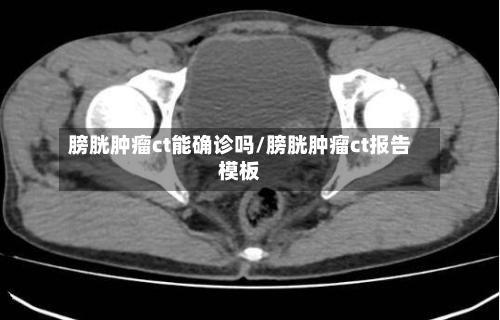 膀胱肿瘤ct能确诊吗/膀胱肿瘤ct报告模板