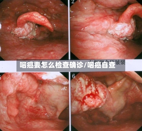咽癌要怎么检查确诊/咽癌自查