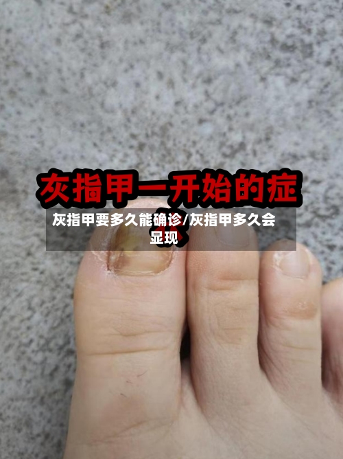 灰指甲要多久能确诊/灰指甲多久会显现-第2张图片