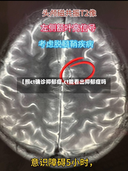 【照ct确诊抑郁症,ct能看出抑郁症吗】-第3张图片