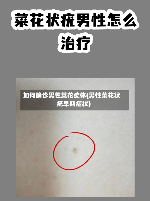 如何确诊男性菜花疣体(男性菜花状疣早期症状)-第2张图片