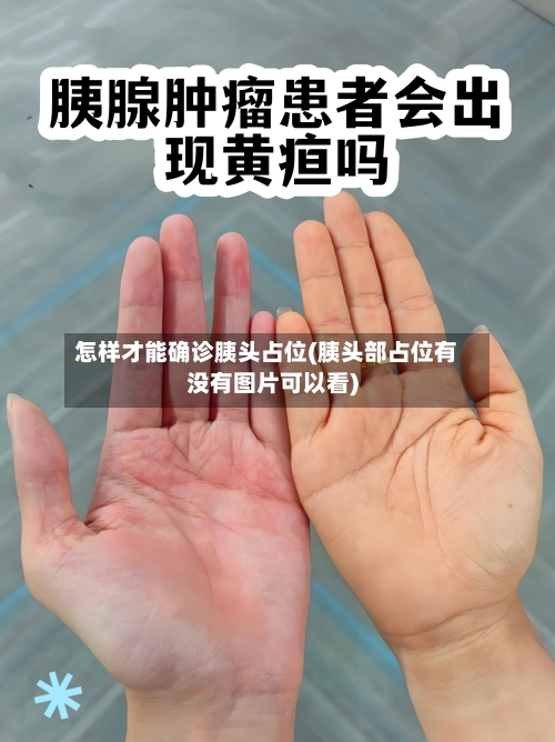 怎样才能确诊胰头占位(胰头部占位有没有图片可以看)-第3张图片