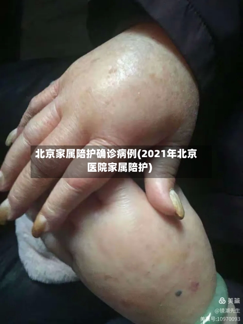 北京家属陪护确诊病例(2021年北京医院家属陪护)-第2张图片