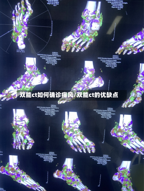 双能ct如何确诊痛风/双能ct的优缺点