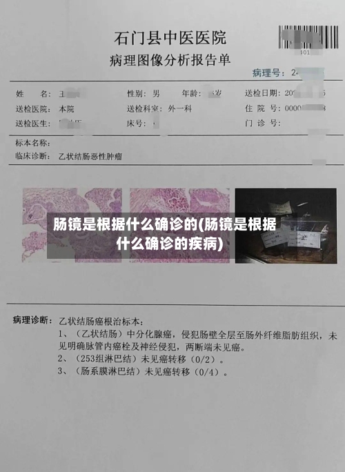 肠镜是根据什么确诊的(肠镜是根据什么确诊的疾病)-第2张图片