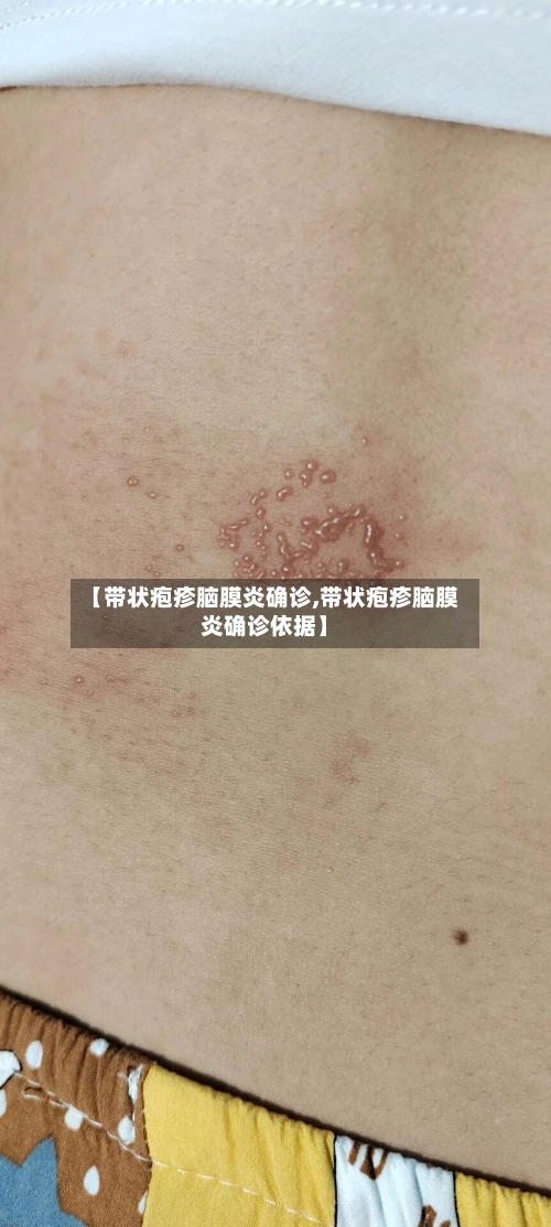 【带状疱疹脑膜炎确诊,带状疱疹脑膜炎确诊依据】-第3张图片