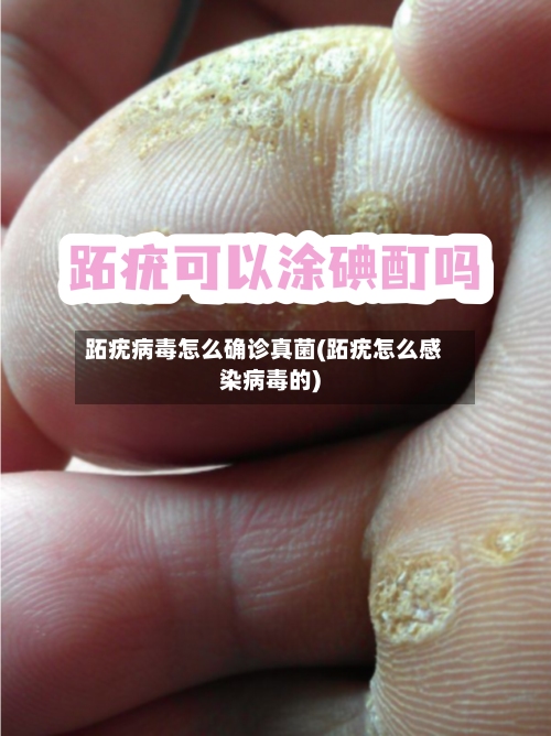跖疣病毒怎么确诊真菌(跖疣怎么感染病毒的)