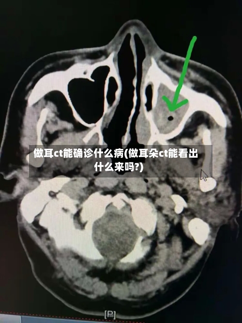 做耳ct能确诊什么病(做耳朵ct能看出什么来吗?)