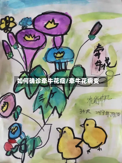 如何确诊牵牛花症/牵牛花病变