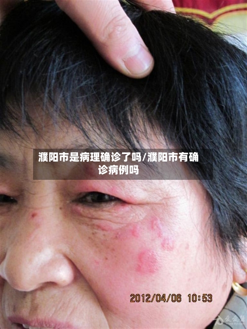 濮阳市是病理确诊了吗/濮阳市有确诊病例吗
