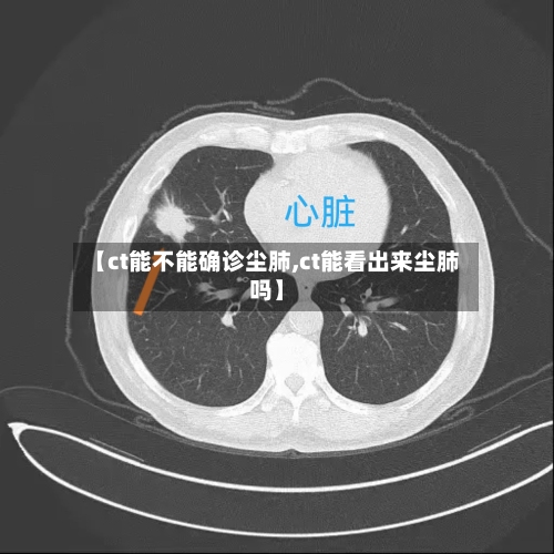 【ct能不能确诊尘肺,ct能看出来尘肺吗】-第3张图片