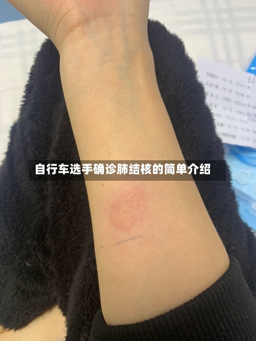 自行车选手确诊肺结核的简单介绍-第2张图片