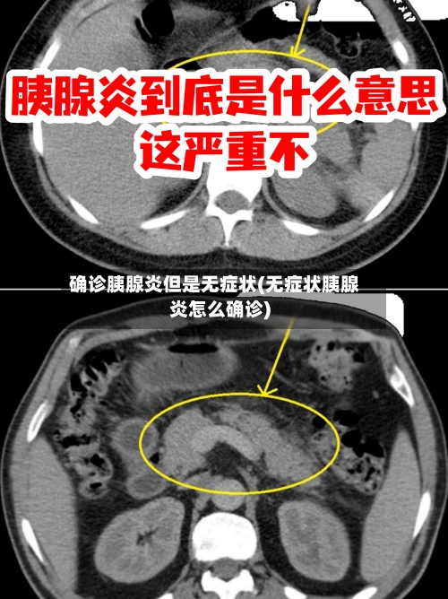 确诊胰腺炎但是无症状(无症状胰腺炎怎么确诊)-第2张图片