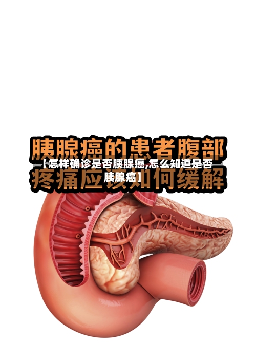 【怎样确诊是否胰腺癌,怎么知道是否胰腺癌】-第2张图片
