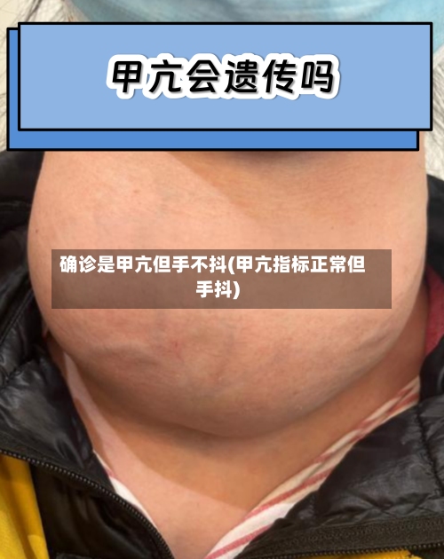确诊是甲亢但手不抖(甲亢指标正常但手抖)-第2张图片