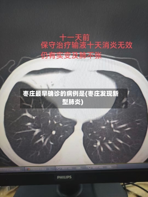 枣庄最早确诊的病例是(枣庄发现新型肺炎)